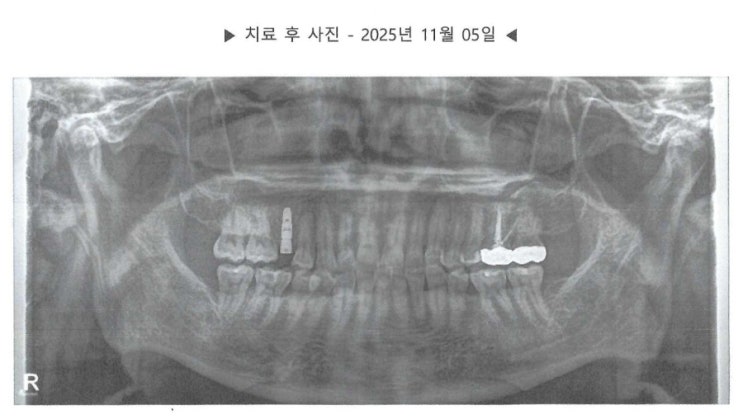 🦷 임플란트 뿌리 시술 후 2일째, 이렇게 관리하세요! : 네이버 블로그