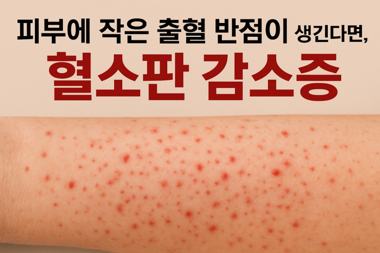 피부에 작은 출혈 반점이 생긴다면, 혈소판감소증 (정의,원인,증상,진단,치료,예방) : 네이버 블로그