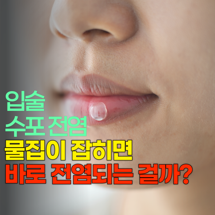 입술 수포 전염 물집이 잡히면 바로 전염되는 걸까? : 네이버 블로그