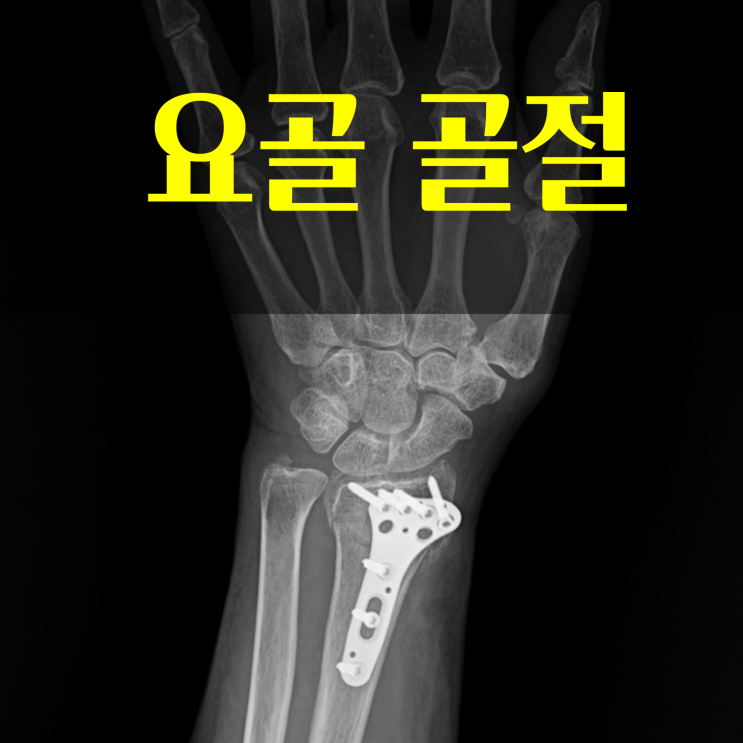 요골 골절 환자에게 필요한 영양소와 접골탕 효과 연구 (논문) : 네이버 블로그
