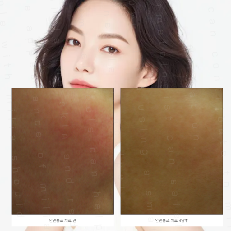 안면 홍조 원인 혈관 반응부터 생활습관까지 한눈에 알아보기 : 네이버 블로그