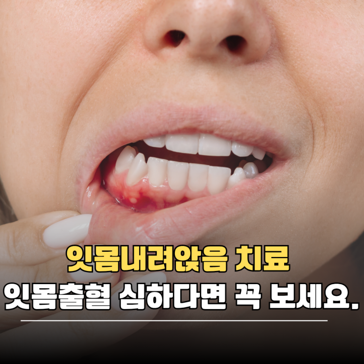 잇몸내려앉음 치료 잇몸출혈 심하다면 꼭 보세요. : 네이버 블로그