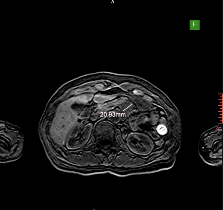 반복되는 복부통증, 췌장MRI 발견된 췌장암 : 네이버 블로그