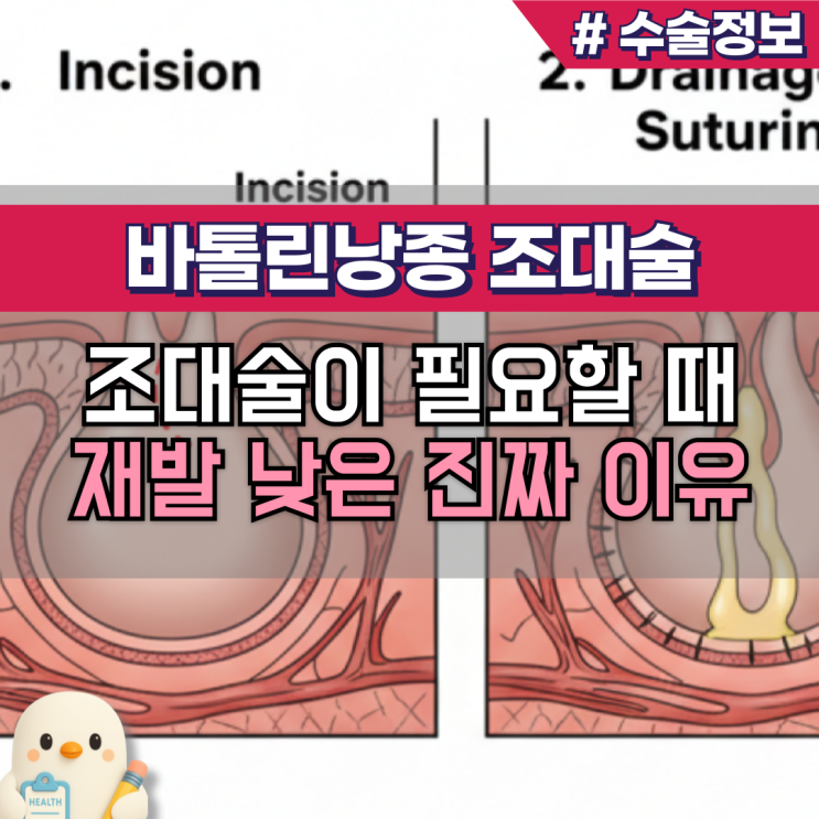 바르톨린선 바톨린낭종 조대술 이해(Marsupialization) : 네이버 블로그