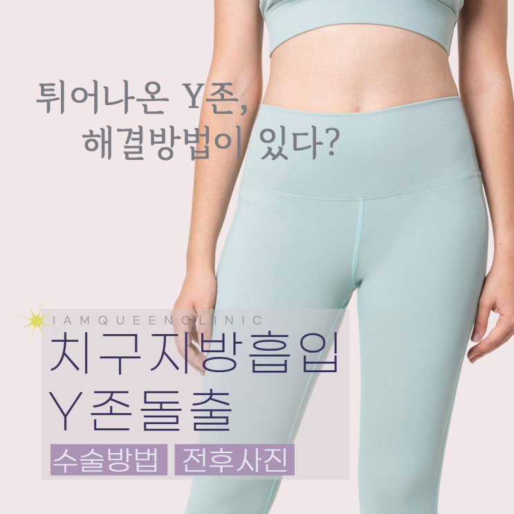 불룩 튀어나온 Y존돌출이 고민이라면 Y존 지방흡입 | 치구지방흡입 대음순거상 : 네이버 블로그