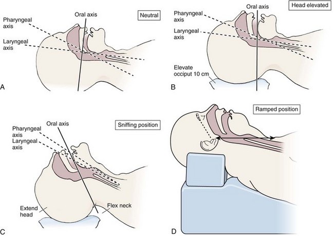 Rapid Sequence Intubation : 네이버 블로그