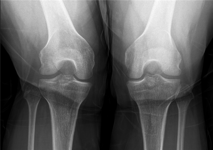 Double anterior horn sign (chronic bucket handle tear) : 네이버 블로그