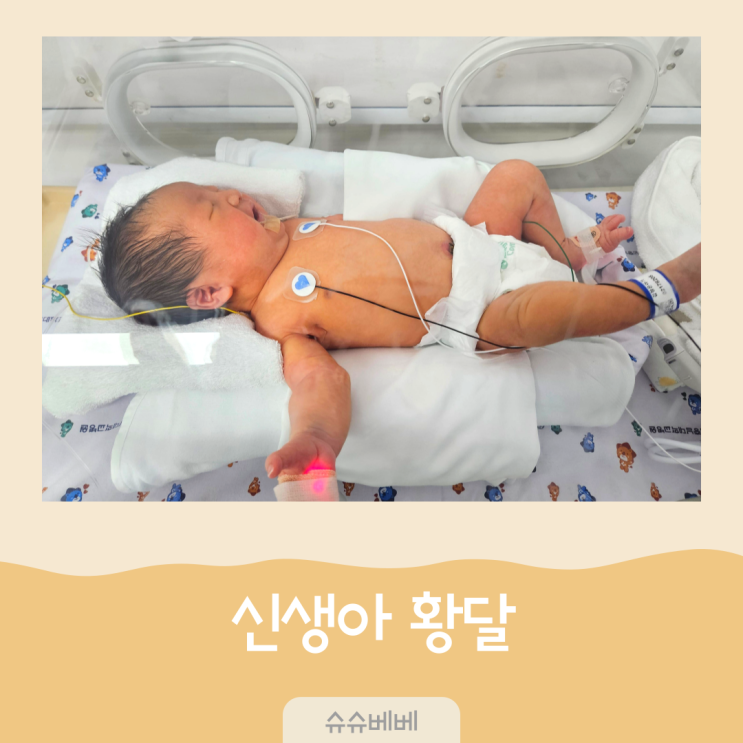 신생아 황달 검사 원인 수치 모유 연관성 치료 방법 : 네이버 블로그