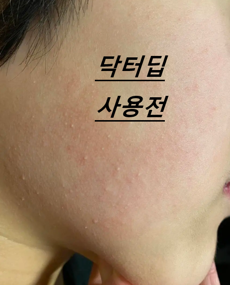 피부 요철 제거 내돈내산 페이스 트러블 관리 기초 케어 : 네이버 블로그