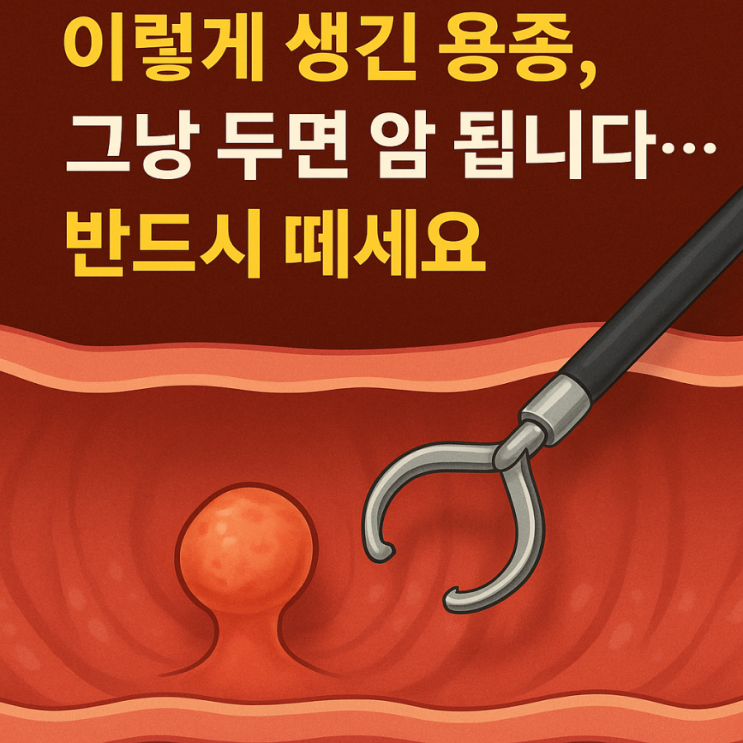 이렇게 생긴 용종, 그냥 두면 암 됩니다… 반드시 떼세요 : 네이버 블로그