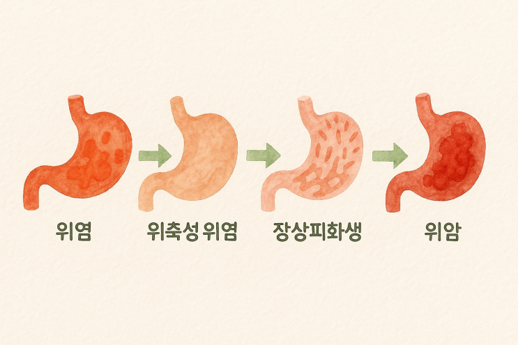 위염, 위축성 위염, 장상피화생.위암으로 가는 과정 알아보기 : 네이버 블로그