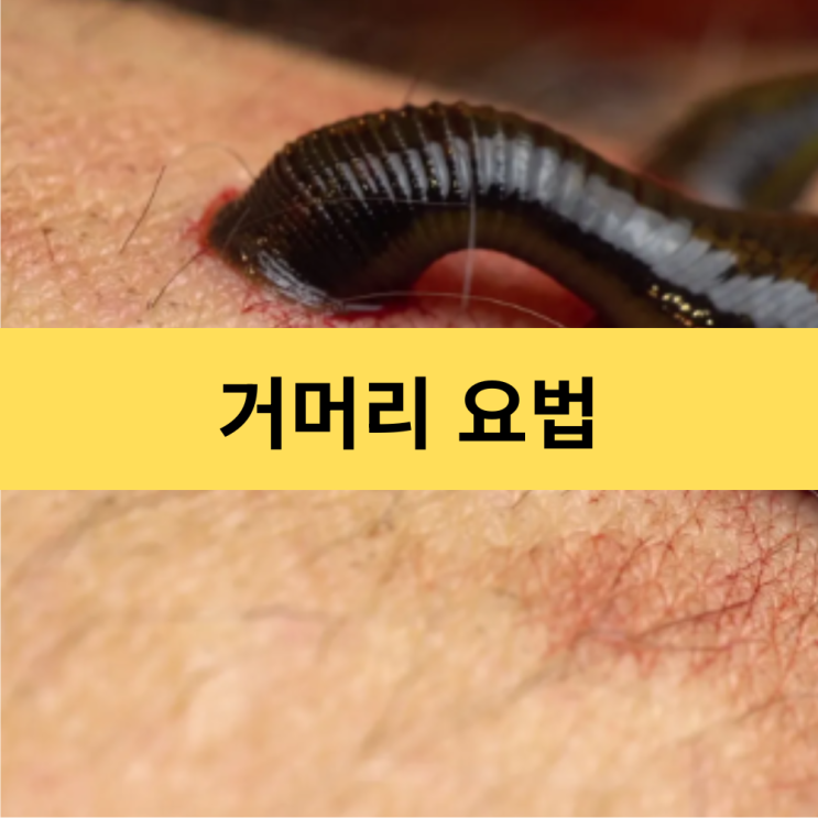 거머리 요법 | 현대 의학에서 재조명받는 거머리의 비밀과 실제 활용 방법 | 히루딘 : 네이버 블로그