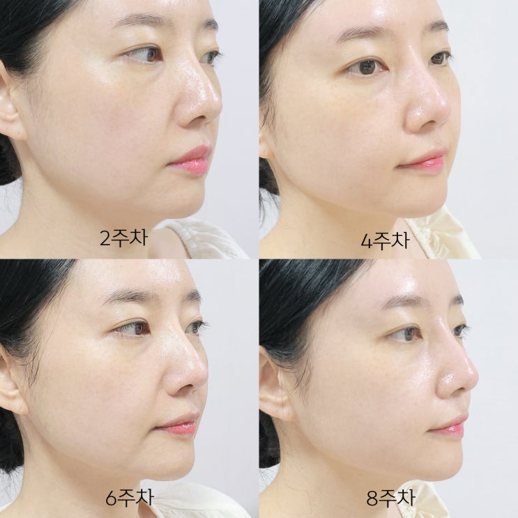 홈쎄라 내돈내산 2개월차 뷰티디바이스 리프팅기기 찐 만족 후기 : 네이버 블로그