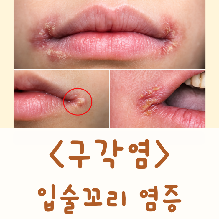 구각염 원인 피부과 병원 연고 비판텐 후시딘 아시클로버 에스로반 구순구각염 : 네이버 블로그
