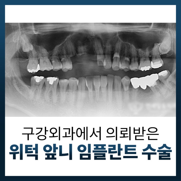 구강 외과에서 의뢰받은 위턱 앞니 임플란트 수술 후기 (feat. 부러진 치아 그리고 치조 골절) : 네이버 블로그