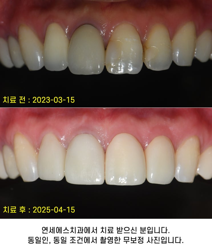 크라운 잇몸 검은색 까매짐, 앞니 신경치료 후 까만색, 레진 착색 치료 : 네이버 블로그