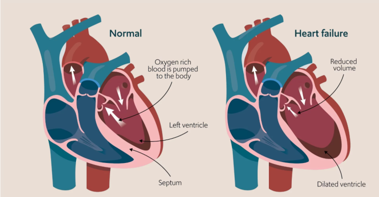 CHF 의학용어 Congestive heart failure 울혈성 심부전 : 네이버 블로그