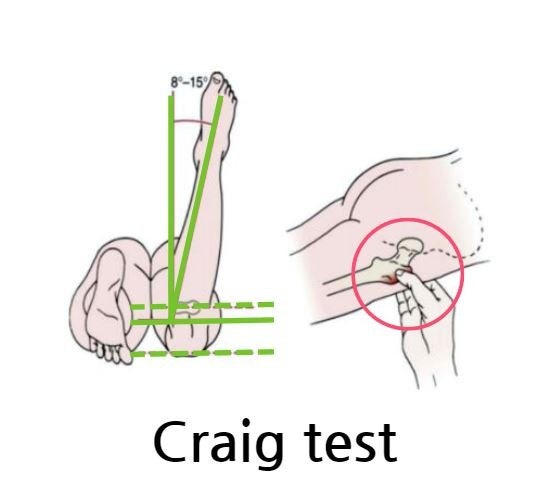 고관절 정렬을 확인하는 방법 : 크레이그 검사(Craig’s Test) : 네이버 블로그