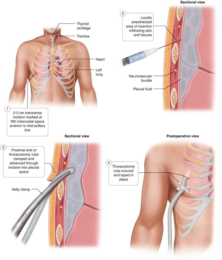 Chest Tube Insertion : 네이버 블로그
