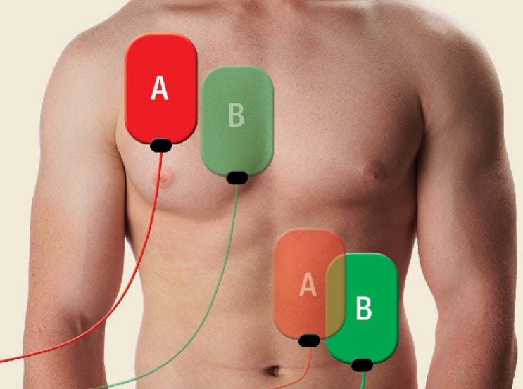제세동 전략 : DSED(Double Sequential External Defibrillation)와 VC(Vector ...
