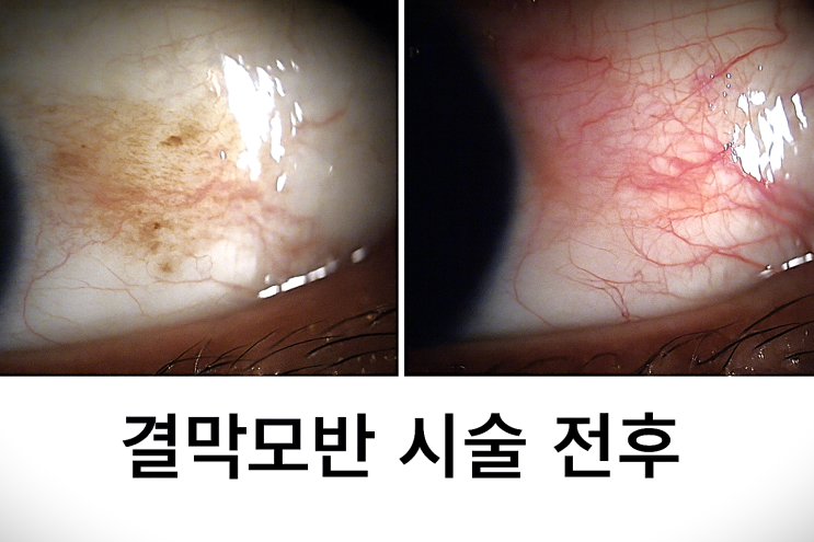 결막모반 진단, 어떤 경우에 치료가 필요할까요? : 네이버 블로그