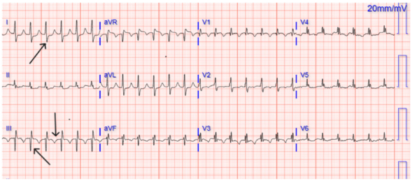 M) STEMI Mimics - pulmonary embolism : 네이버 블로그