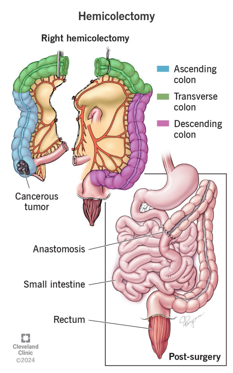 [간호] Colectomy, 수술실 근무 466일차. : 네이버 블로그
