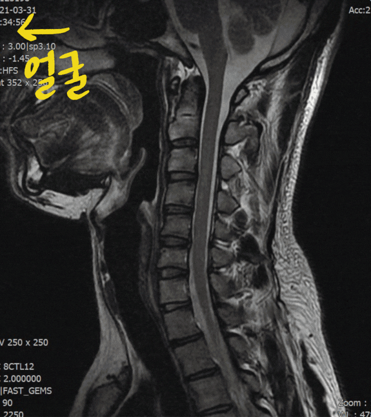 목 MRI 보는 법, 경추 MRI 일반인도 쉽게 판독하는 방법. : 네이버 블로그