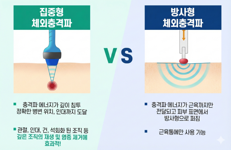 [혜성민가족의원]체외충격파(ESWT) 집중형 vs 방사형 차이점 완벽 정리 : 네이버 블로그