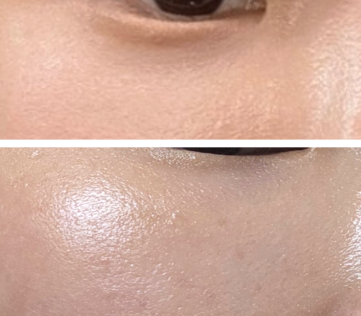 청담피부과 눈밑주름 다크서클 시술 아이공주사 효과 후기 : 네이버 블로그