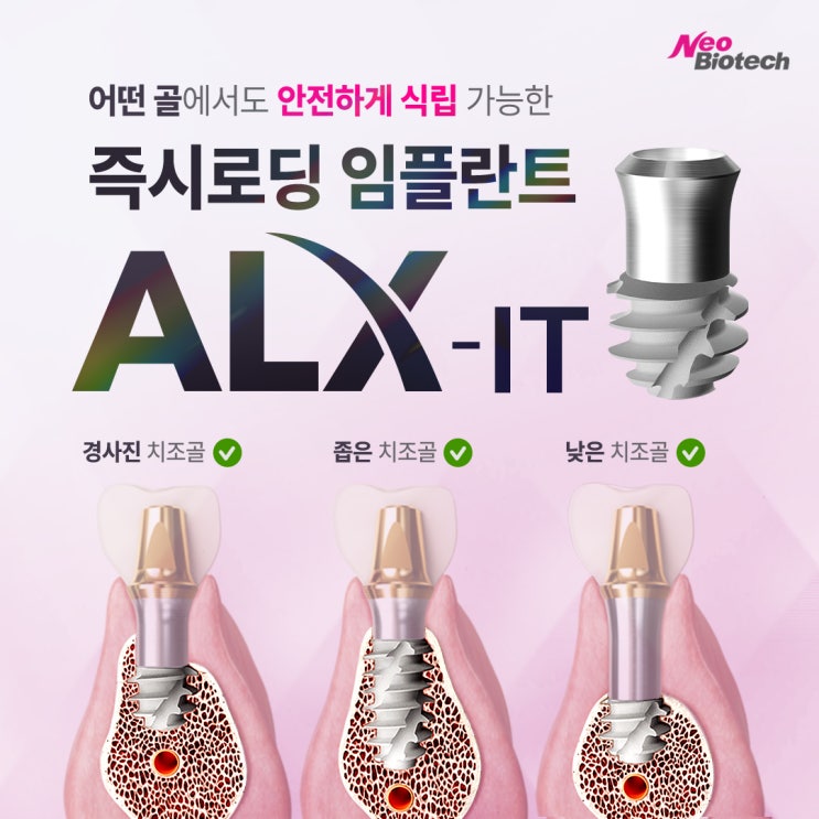 어떤 골에서도 안전하게 식립 가능한 즉시로딩 임플란트 'ALX-IT' : 네이버 블로그
