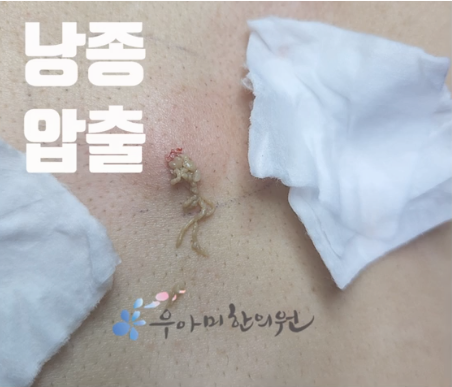 종기 원인, 단순 뾰루지와 다른 3가지 신호 : 네이버 블로그