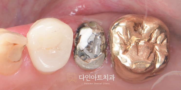 신경치료, 중간에 중단하면 어떻게 될까요? [광교신도시 치과, 상현역 치과]