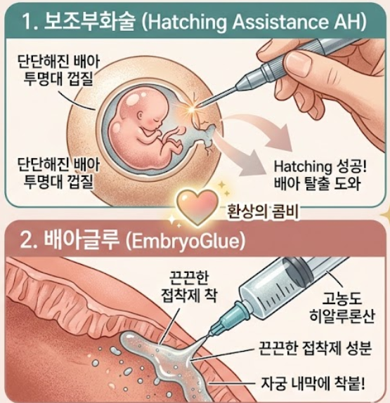 [IVF 일기] 착상 확률을 높이는 '치트키'? 보조부화술(AH)과 배아글루(EmbryoGlue) 정리 : 네이버 블로그