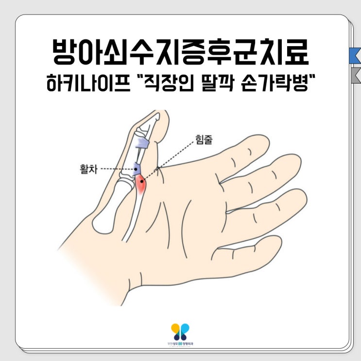 방아쇠수지증후군치료 하키나이프 