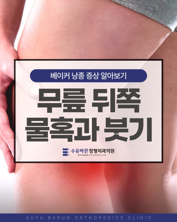 무릎 뒤쪽(오금) 물혹과 부음 증상, 베이커 낭종 확인하세요 (치료법 안내) : 네이버 블로그