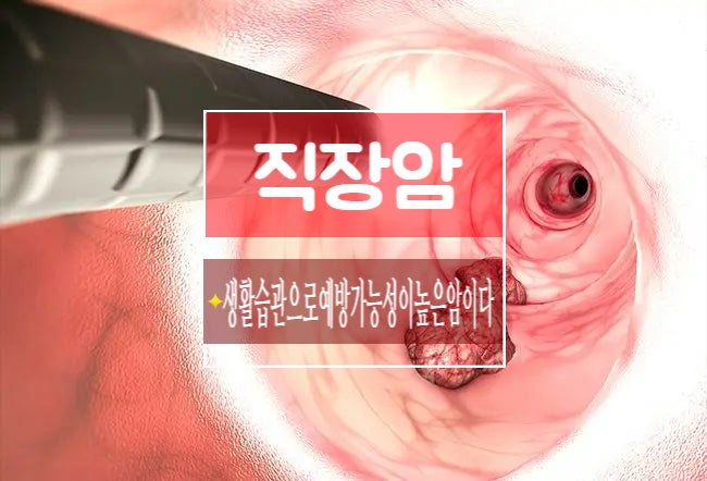 직장암 생활습관으로 예방 가능성이 높은 암이다 : 네이버 블로그