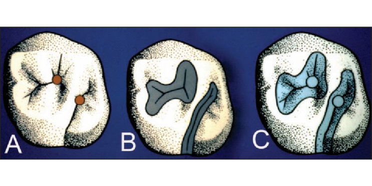 Biomimetic Dentistry 이야기: Part1. 왜 Biomimetic인가?