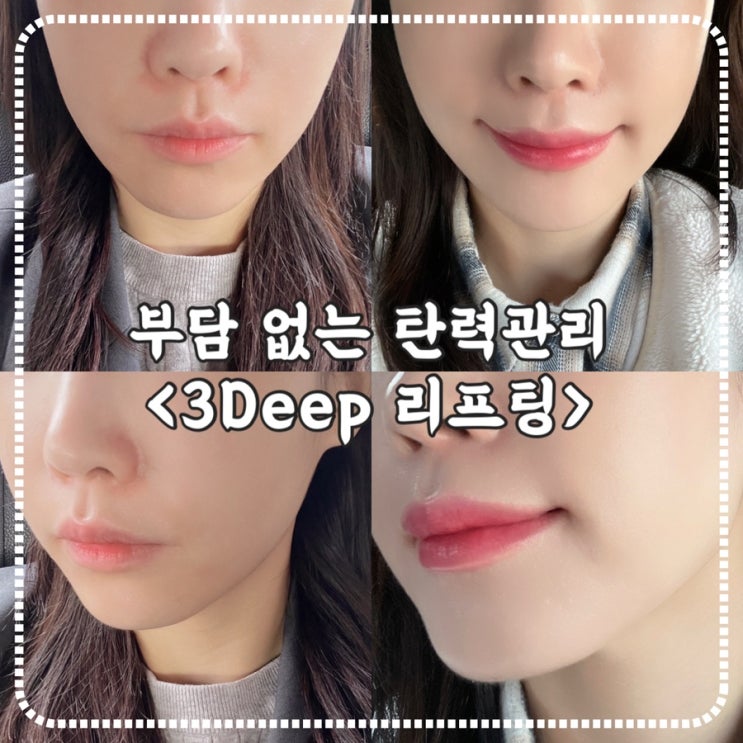 서울청담동리프팅 3Deep 써마지보다 부담없이 받아봄 : 네이버 블로그