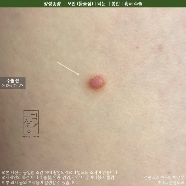 [피부양성종양] 종아리의 섬유종 제거 후기 : 네이버 블로그