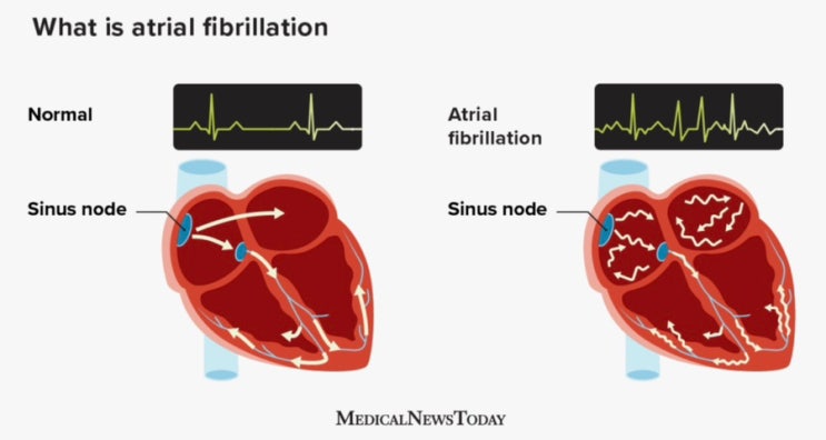 심방세동 Atrial Fibrillation with RVR (Rapid Ventricular Rhythm), 치료 약물 ...