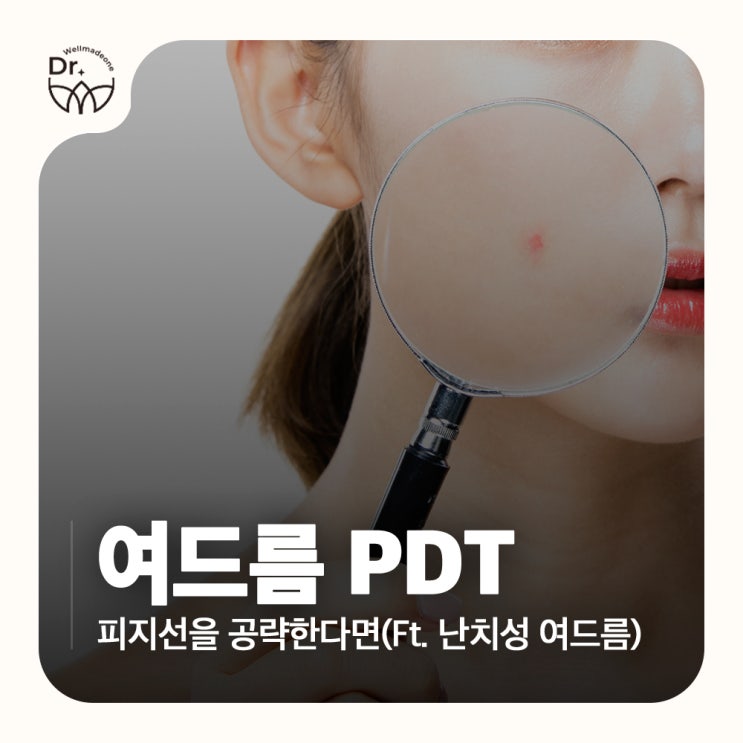 여드름 PDT 레이저 효과, 피지선을 공략한다면(Ft. 난치성 여드름) : 네이버 블로그