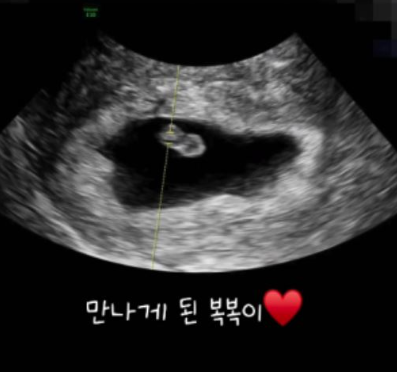 이지훈 아야네 두 번의 유산 딛고 '복복이' 임신! "입덧도 감사" 눈물의 고백