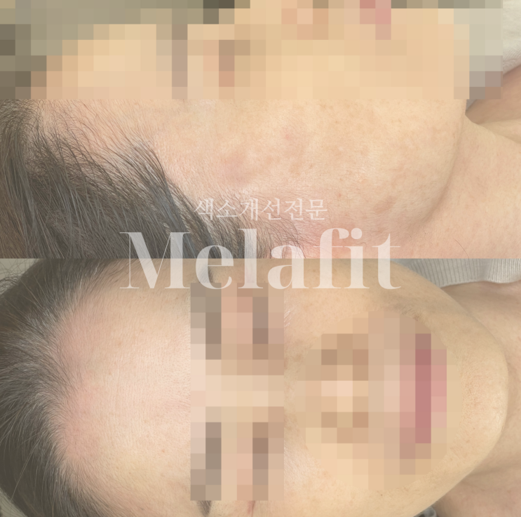 위고비, 마운자로 시작 전에 아무도 안 알려준 피부 망가짐 : 네이버 블로그