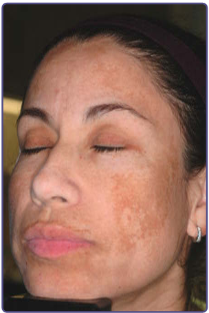 과색소질환 (Disorders of hyperpigmentation) (3) : 염증후 색소침착, 기미 : 네이버 블로그