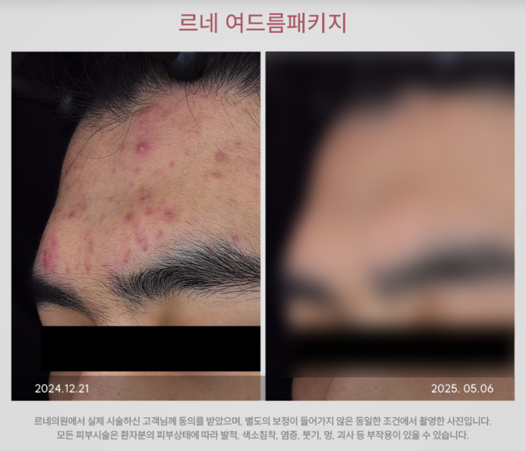 영종도 여드름치료 4단계 정리 : 네이버 블로그