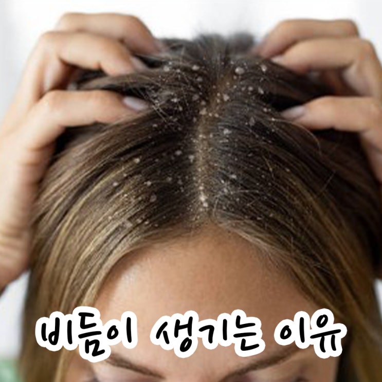 자꾸 비듬이 생기는 이유와 종류 원인별로 없애는 방법