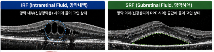 황반변성 OCT에서 ‘이 물’이 보이면 위험합니다 (IRF vs SRF 최신 연구 총정리) : 네이버 블로그