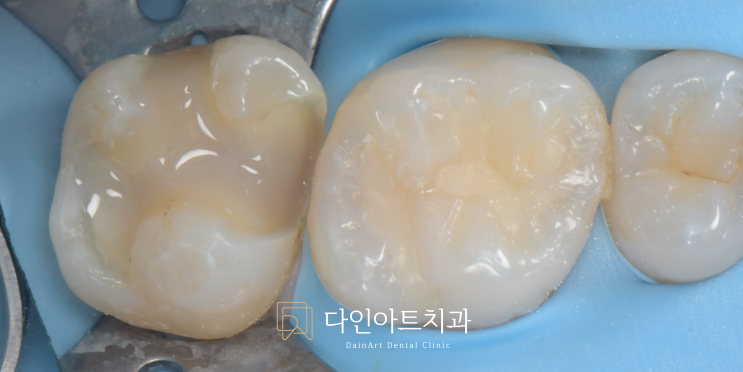 Biomimetic Dentistry 이야기: Part 5. 즉시 상아질 밀폐(IDS)와 Resin Coating Technique