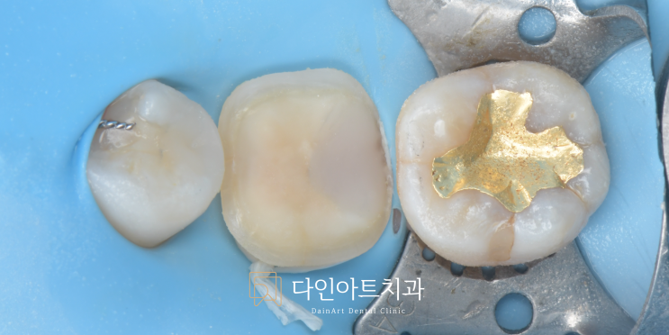 Biomimetic Dentistry 이야기: Part 6. Deep Margin Elevation(DME)